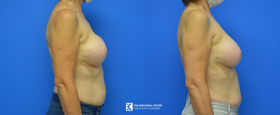 Breast Implant Removal In Chicago