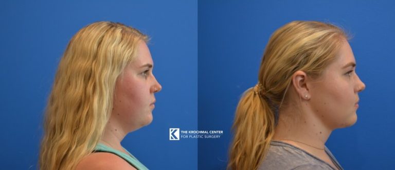 Neck liposuction in Naperville