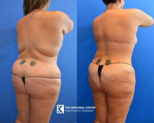 Bra line backlift near Chicago to contour the back and get rid of bra rolls