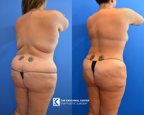 Bra Line Backlift Photos in Chicago with Dr. Krochmal