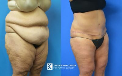 Tummy tuck for weight loss