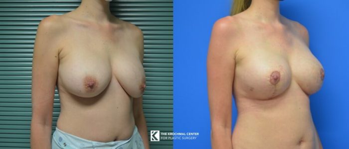 Breast implant exchange with breast lift near Chicago