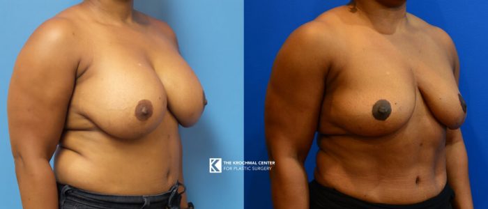 Breast implant removal with breast lift for breast pain