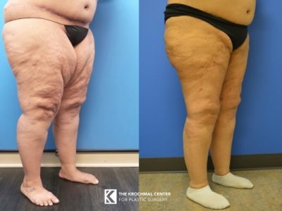 Frequently Asked Questions About Lipedema Progression
