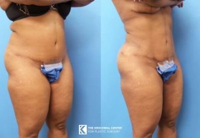Liposuction etching abs Plastic Surgery