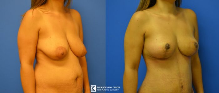 Cosmetic Surgeon Chicago Breast Lift