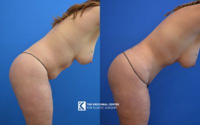 Abdominoplasty with liposuction