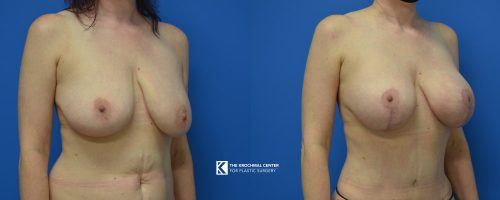 Naperville Breast Augmentation