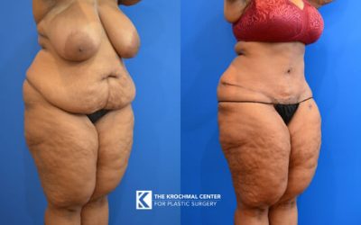 Tummy Tuck after weight loss in plus size person near Naperville