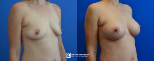 Breast Implants near me in Chicago