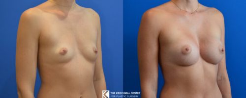 Naperville breast augmentation result from cosmetic surgeon Daniel Krochmal