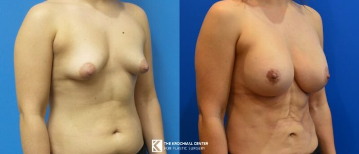 Beautiful breast augmentation with breast implants in Chicago