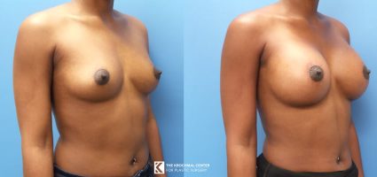 Chicago breast augmentation Krochmal