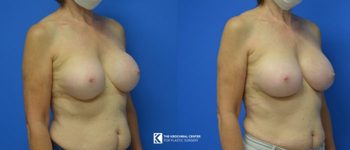 En Bloc Breast Implant Exchange