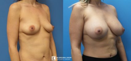 Breast augmentation Chicago Cosmetic