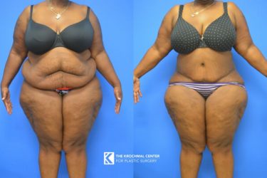 Chicago, Hinsdale, Oak Brook, and Naperville Tummy Tuck