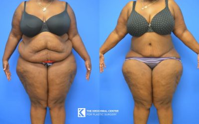 Chicago and Hinsdale Abdominoplasty and Tummy Tuck Photos