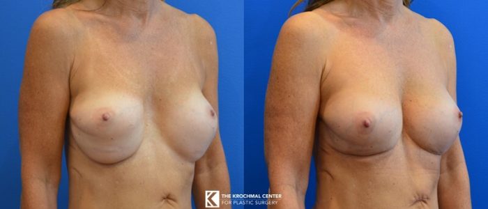 Improving breast appearance after botched breast augmentation