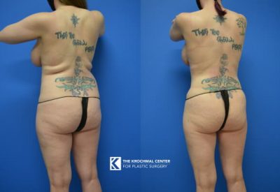 Back Shaping with Liposuction