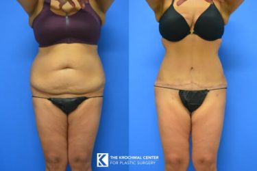 Chicago, Hinsdale, Oak Brook, and Naperville Tummy Tuck