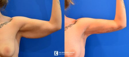 Beautiful arm lift result near Chicago by Aesthetic Surgeon Daniel Krochmal
