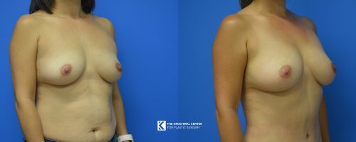 Breast augmentation in Chicago