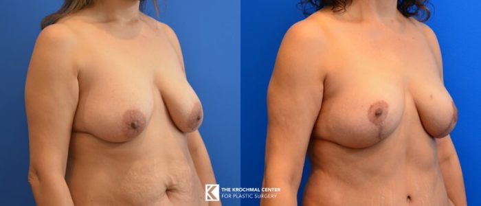Breast lifting with a mastopexy by Daniel Krochmal