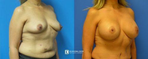 Breast augmentation with lift near Chicago
