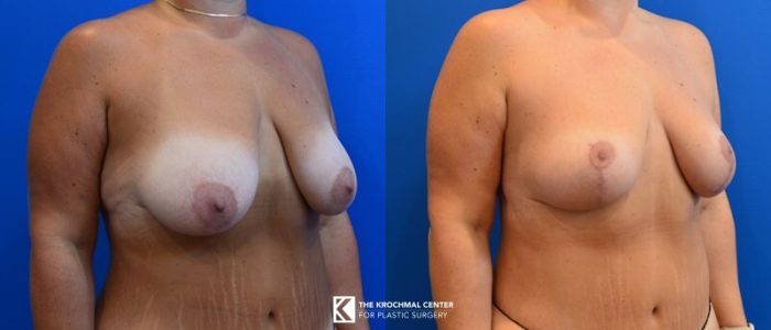 Chicago breast lift results