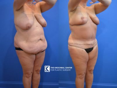 Tummy tuck and breast lift near Downers Grove
