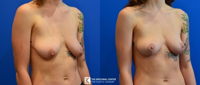 Breast lift mastopexy in Chicago results
