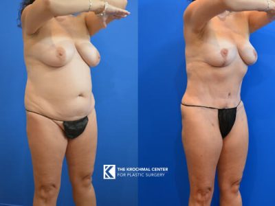 Abdominoplasty with breast lift near Hinsdale with a great result