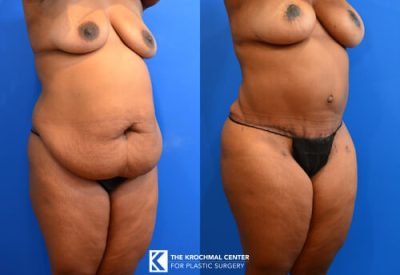 Plus size abdominoplasty for high BMI patients near Chicago